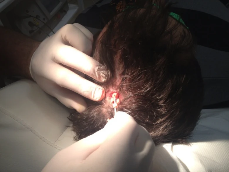 Odstranění ateromu z kůže hlavy lékařem v rukavicích.