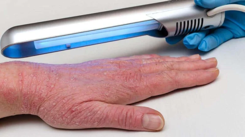UV lampa na ruce s ekzémem při léčbě.