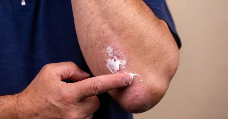 Man applying cream to rash