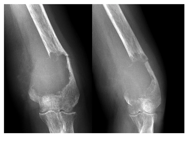 Rentgenová snímka kosti s metastázou v lokti
