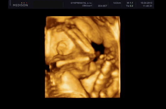 Fetus in womb